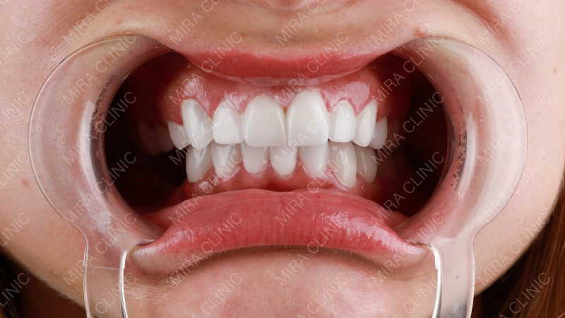 Veneers Before - After